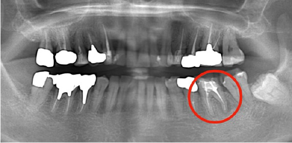 Case01 治療前のレントゲン1