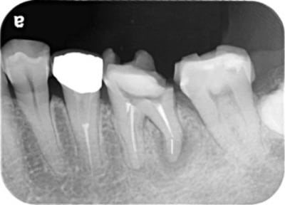 Case01 治療前のレントゲン2