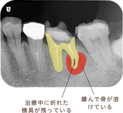 治療中に折れた器具が残っている・膿んで骨が溶けている