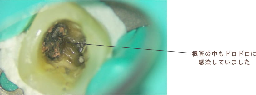 根管の中もドロドロに感染していました
