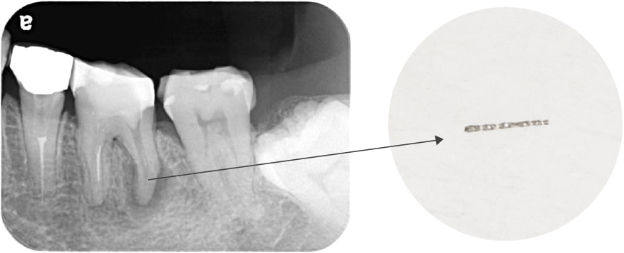 Case01 折れて残っていた機具の写真
