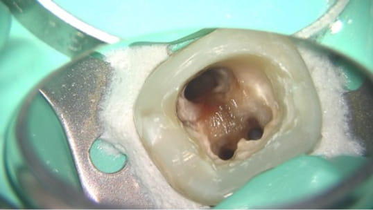 Case01 根管の中を洗浄した写真