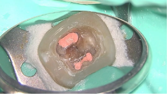 Case01 根管の中を封鎖した写真