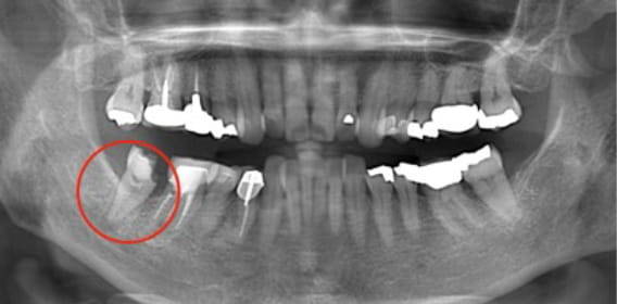 Case02 治療前のレントゲン1