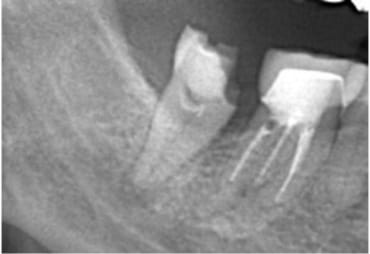 Case02 治療前のレントゲン2