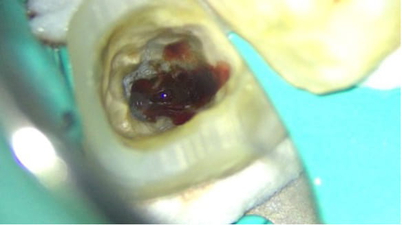 Case02 膿が出ている写真