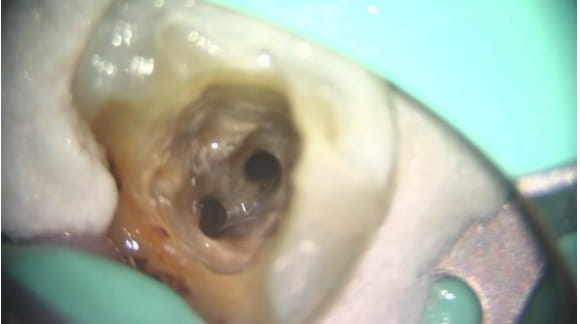 Case02 根管の中を洗浄した写真