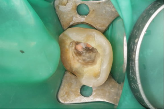 Case02 根管の中を封鎖した写真