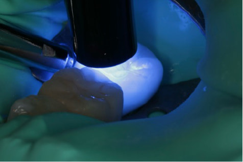 Case02 上から被せを精密に接着させた写真