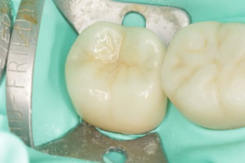 Case02 治療直後の写真